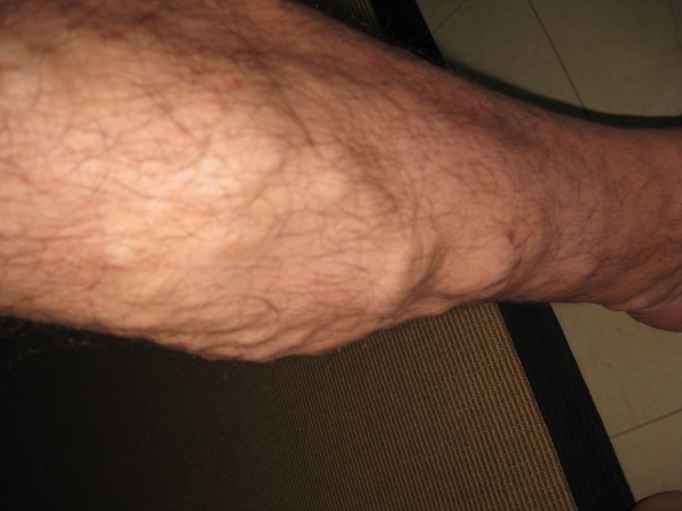 health-suddenly-swollen-and-sore-leg-should-know-in-advance